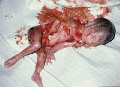 abortedbaby05